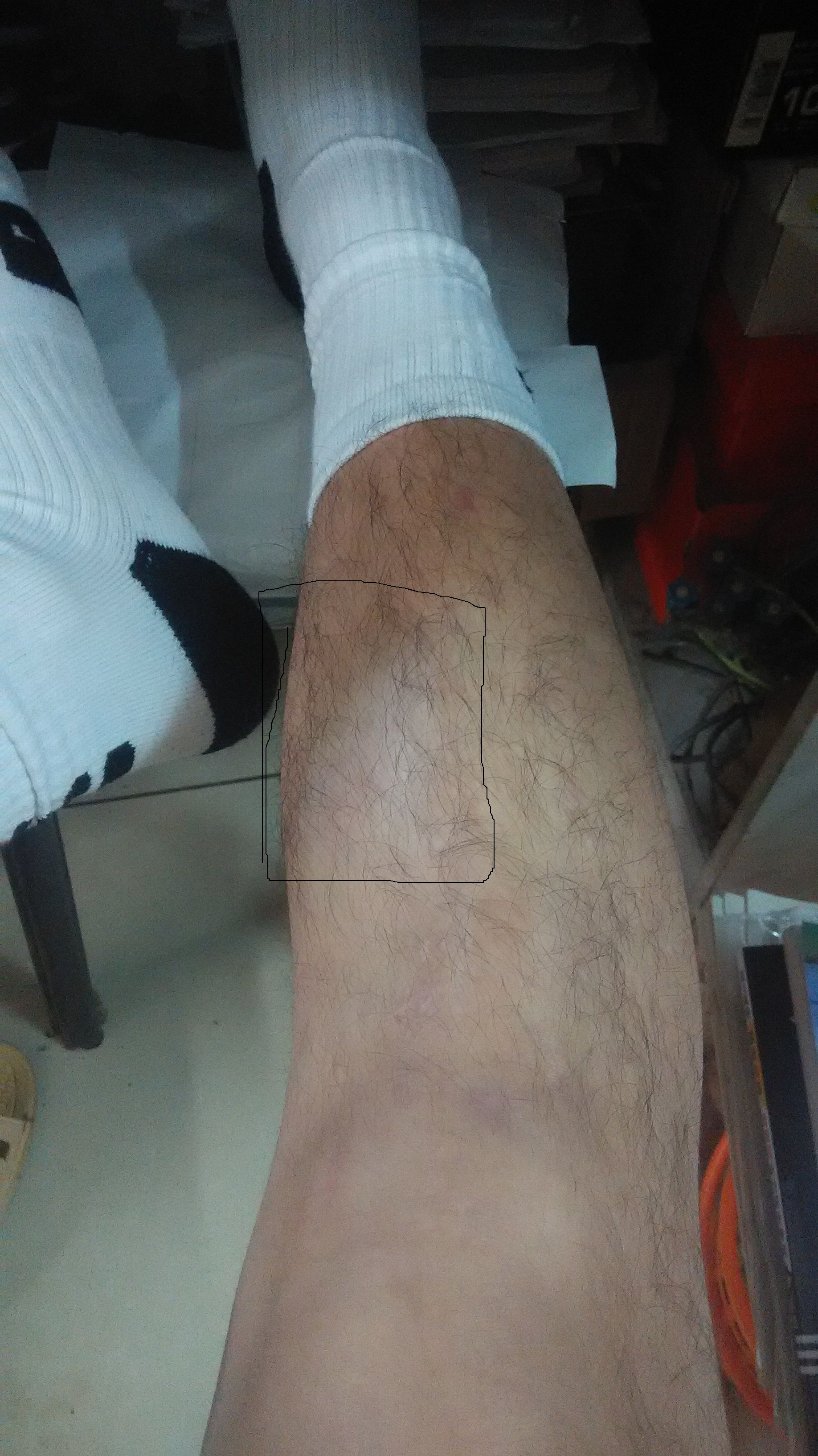 Calf muscle strain (What medicine should I use for a calf muscle strain)